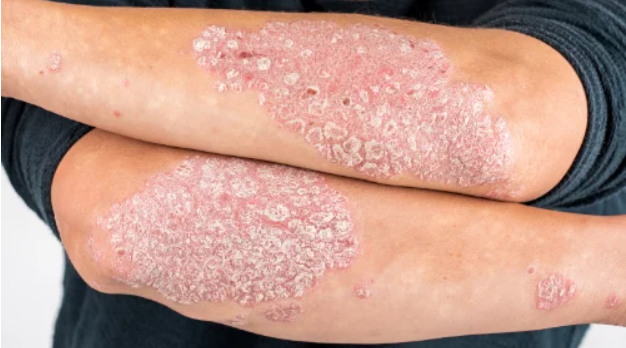 Psoriasis treatment at OEA