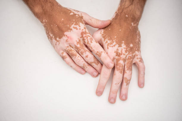Vitiligo treatment at OEA